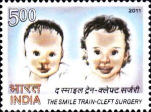 Cleft Lip Repair