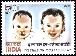 The Smile Train – Cleft Surgery